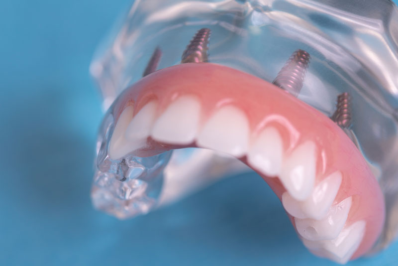 full arch dental implants model