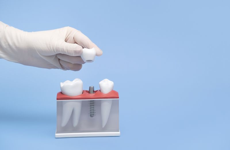 hand in a white glove holds a model of a tooth implant blue table and background.