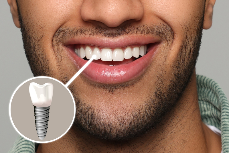 Happy man with perfect teeth smiling on grey background, closeup. Illustration of dental implant.