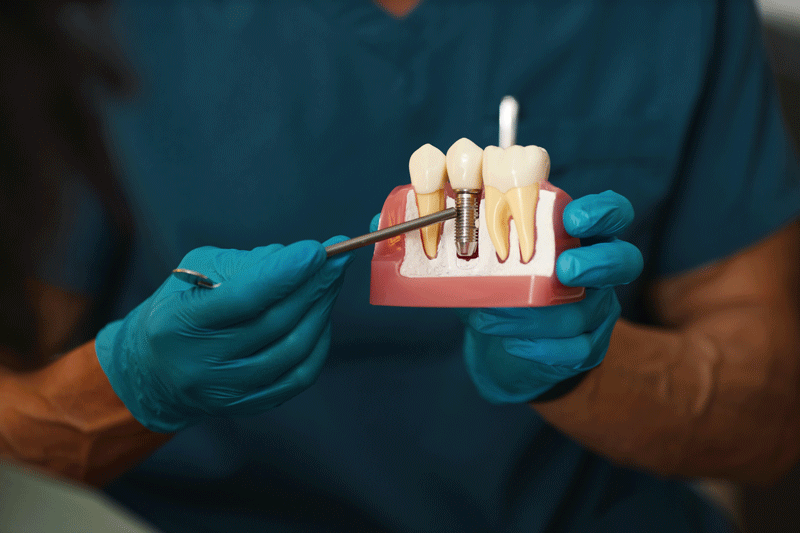 Dentist holding dental implant, artificial tooth roots into jaw, root canal of dental treatment, gum disease, teeth model for dentist.